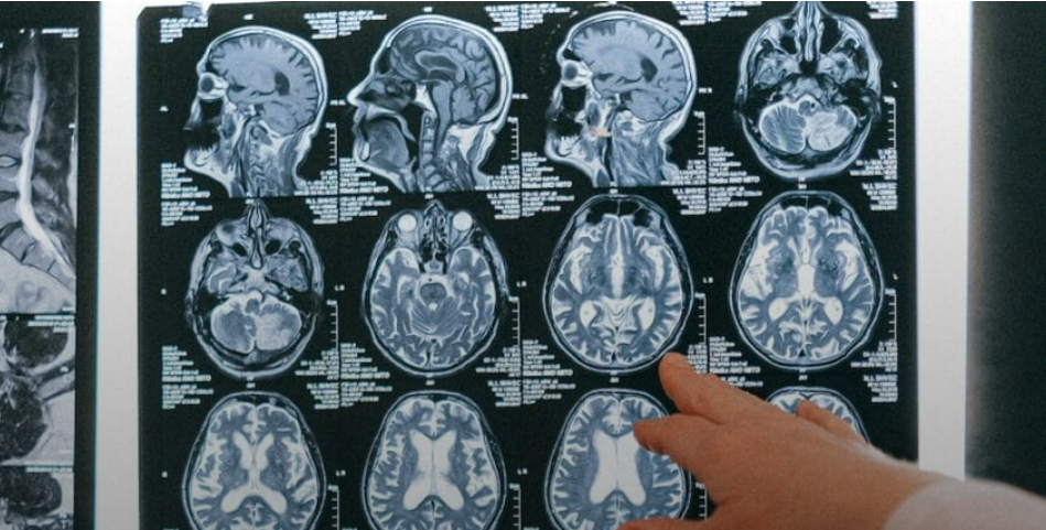 Lees meer over het artikel De kracht van overtuiging: Hoe placebo’s ons pijngevoel beïnvloeden